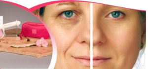 Aparat de intinerire faciala cu OXIGEN, ingrijire faciala, aparat cosmetica